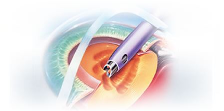 http://www.noorvision.com/images/20130220124243phaco.jpg