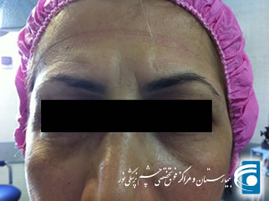 تصویر بالا بردن بالا بردن ابروها به روش آندوسکوپیک پیش از عمل