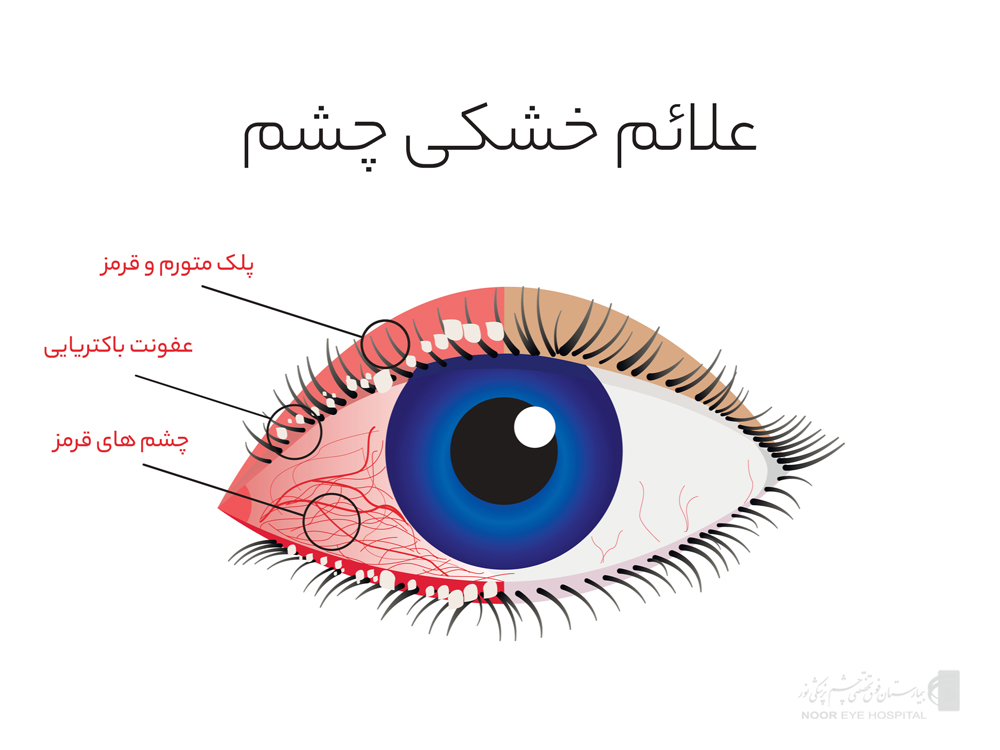 علائم خشکی چشم