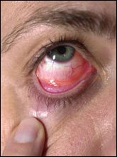 کنژنکتیویت یا التهاب ملتحمه (Conjunctivitis)