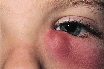 داکریوسیستیت چیست؟