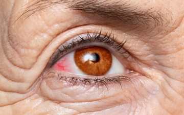 Glaucoma Surgery