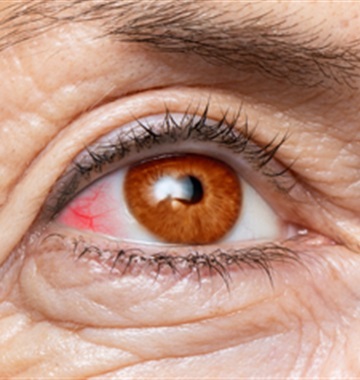 Glaucoma Surgery