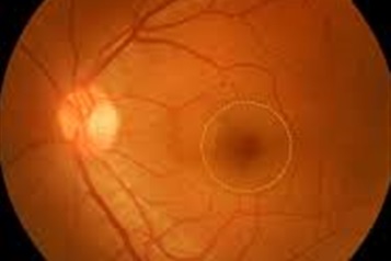 سوراخ ماکولا