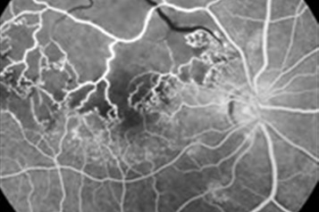 آنژیوگرافی فلوروسین