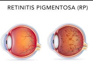 رتینیت پیگمانتوزا (Retinitis Pigmentosa)