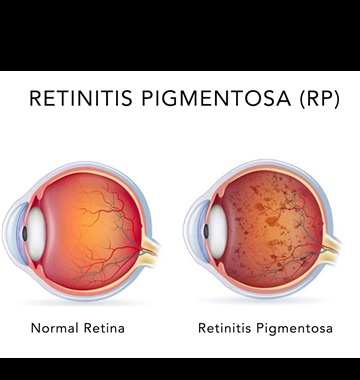 رتینیت پیگمانتوزا (Retinitis Pigmentosa)