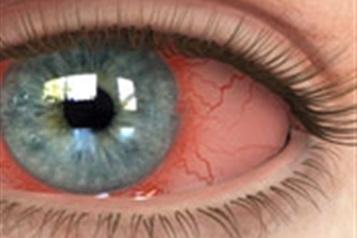 اثر دیابت بر روی شبکیه