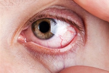 برای خشکی چشم چی بخوریم؟