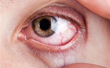 برای خشکی چشم چی بخوریم؟