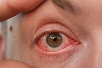 سوزش چشم را جدی بگیریم