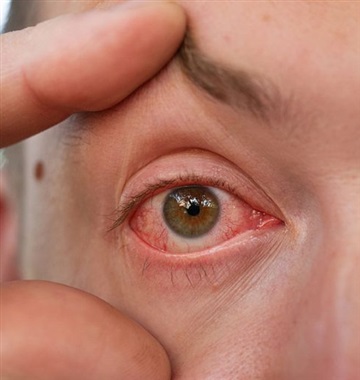 سوزش چشم را جدی بگیریم