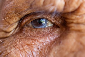 آب مروارید سالمندان