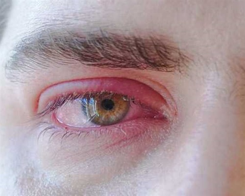 شالازیون (Chalazion)