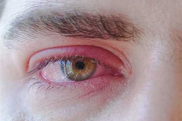 شالازیون (Chalazion)