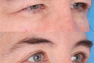 عوارض عمل جراحی زیبایی پلک