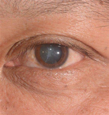 آب مروارید چشم (کاتاراکت)