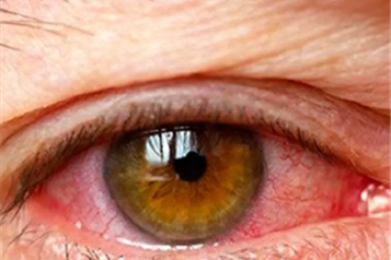  فشار چشم چیست و چگونه بوجود می آید؟