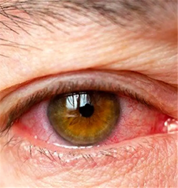 فشار چشم چیست و چگونه بوجود می آید؟