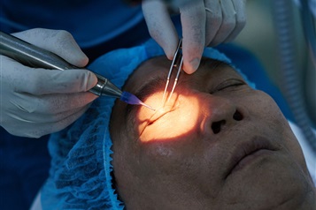 درمان لیزری کاهنده فشار داخل چشم