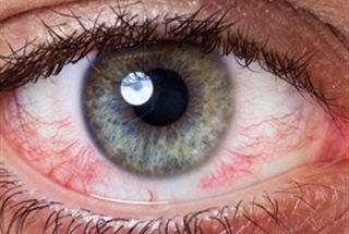 آیا با وجود خشکی چشم می توان عمل لیزیک انجام داد؟