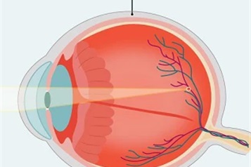 ارتوكراتولوژی برای درمان نزدیک بینی