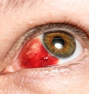 خونریزی زیر ملتحمه (Subconjunctival Hemorrhage)