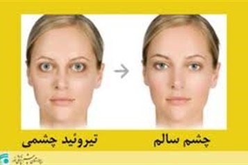 بیماری تیروئید چشمی