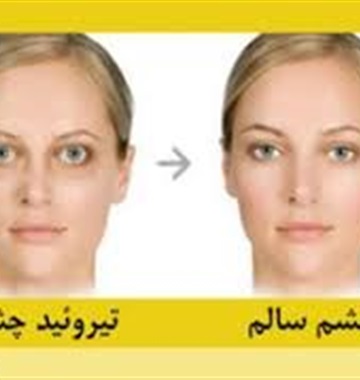 بیماری تیروئید چشمی
