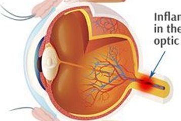 التهاب عصب بینایی