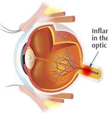 التهاب عصب بینایی