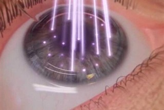 لیزر اگزایمر چیست و چه کاربردی دارد؟