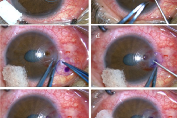 تکنیک های رایج عمل جراحی قرنیه