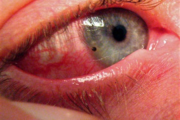 تاثیر ضربه های چشمی بر بینایی کودکان