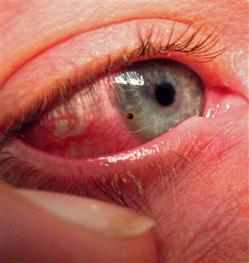 تاثیر ضربه های چشمی بر بینایی کودکان