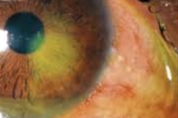 ساییدگی و خراشیدگی قرنیه چگونه اتفاق می‌افتد؟