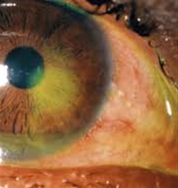 ساییدگی و خراشیدگی قرنیه چگونه اتفاق میافتد؟