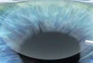 مقایسه عمل فیکوکاتاراکت و فمتوکاتاراکت