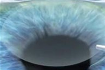 مقایسه عمل فیکوکاتاراکت و فمتوکاتاراکت