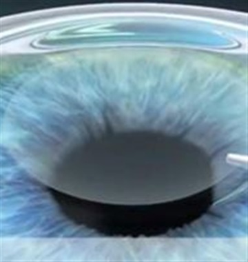 مقایسه عمل فیکوکاتاراکت و فمتوکاتاراکت