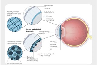 دیستروفی فوکس قرنیه از تشخیص تا درمان