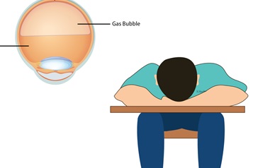 خوابیدن به صورت پس از جراحی شبکیه