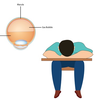 خوابیدن به صورت پس از جراحی شبکیه