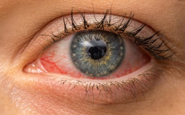 Ocular Brachytherapy 