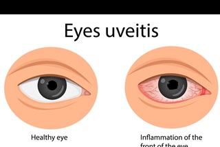 یووئیت (Uveitis)