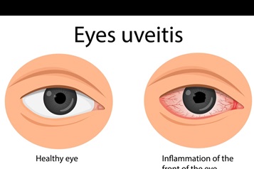 یووئیت (Uveitis)