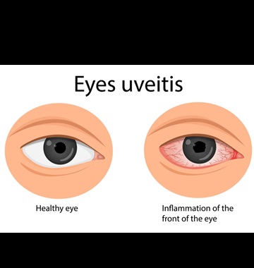 یووئیت (Uveitis)