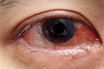 سوختگی های چشمی را جدی بگیرید