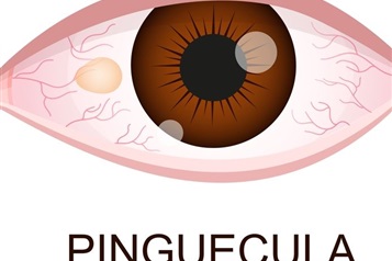 ناخنک و پینگوکولا چه تفاوتی دارند؟