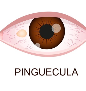 ناخنک و پینگوکولا چه تفاوتی دارند؟